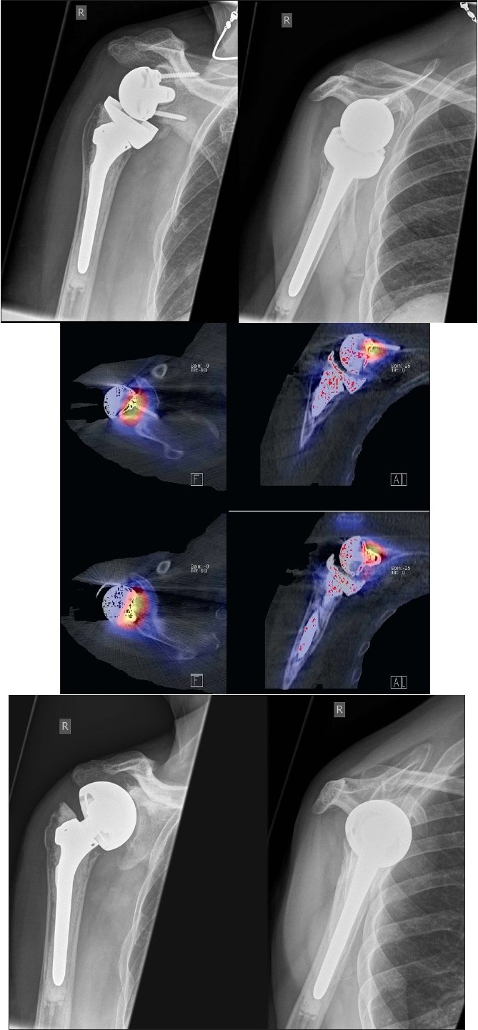 Figure 2: (a)Anterior-posterior and y-view radiographs of the right shoulder showing wide radiolucent lines around the glenoid peg
Figure 2b: 99mTc-HDP-SPECT/CT showing increased tracer uptake at the glenoid component-host bone interface, which was interpreted as clear sign for mechanical loosening
Figure 2c: Anterior-posterior and y-view radiographs of the right shoulder after revision to a bipolar cup prosthesis