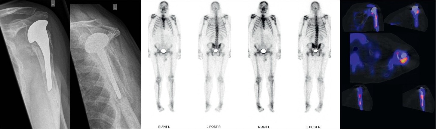 Figure 3: (a)Anterior-posterior and y-view radiographs of the left shoulder indicating radiolucent lines around the humeral stem
Figure 3b: Planar scintigraphy and 99mTc-HDP-SPECT/CT showing increased tracer uptake around the humeral stem, which was caused by mechanical loosening