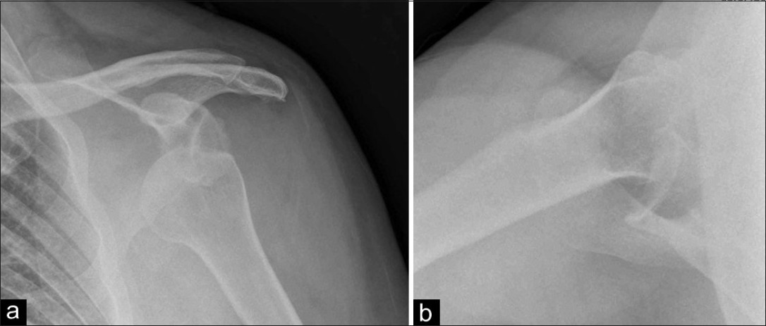 Figure 1: (a,b)Plain radiographs, AP and axillary views identifying humeral head lying inferior to the glenoid cavity. Radiologist initially suspected a fracture of the glenoid labrum, a Bankart lesion