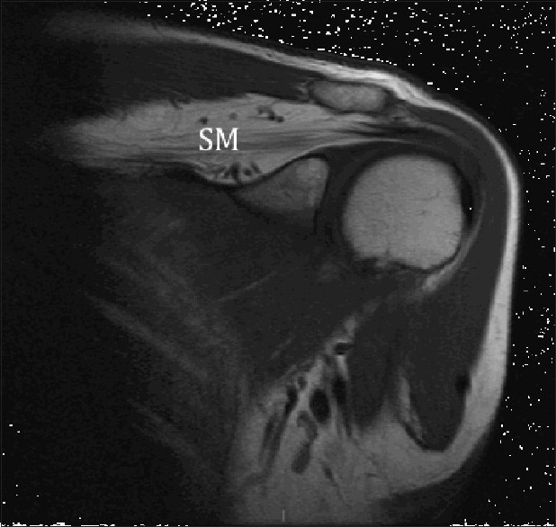 Figure 1: Magnetic resonance imaging coronal view showing significant atrophy and fatty infiltration of the supraspinatus muscle