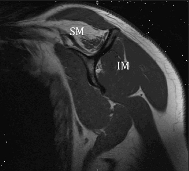 Figure 2: Magnetic resonance imaging oblique view showing significant fatty infiltration of the supraspinatus muscle; Note the normal appearance of the infraspinatus muscle
