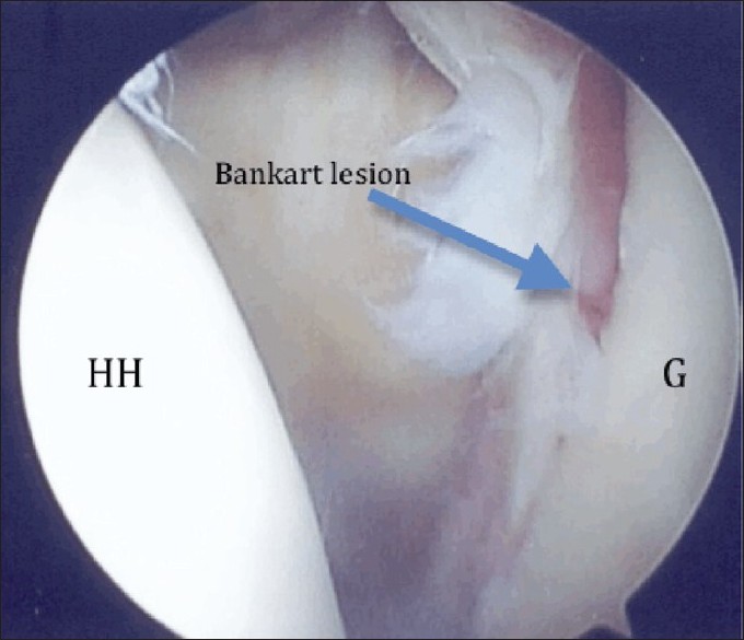 Figure 3: Arthroscopy of the shoulder showing Bankart lesion of the glenoid (posterior portal view). HH: Humeral head, G: Glenoid