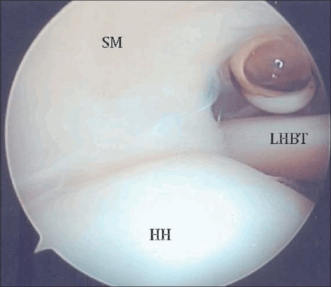 Figure 4: Arthroscopy of the shoulder showing the normal appearance of the supraspinatus tendon (posterior portal view). HH: Humeral head, SM: Supraspinatus muscle, LHBT: Long head of biceps tendon