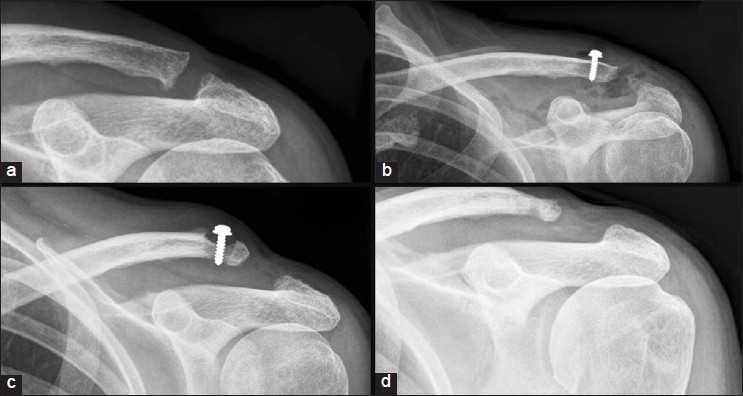 Figure 1: (a) Disruption of the Acromio-clavicular joint, (b) Immediate postoperative radiograph demonstrating Surgilig screw <i>in situ</i>, (c) Follow-up radiograph demonstrating osteolysis of the clavicle around the screw with associated soft tissue swelling, (d) Radiograph taken after removal of implant demonstrating no further bone loss