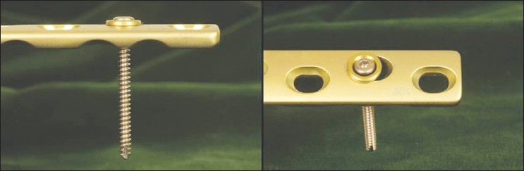 Figure 1: 3.5 cortical screw with a washer fits into a large 4.5 AO LC-DCP (limited-contact dynamic compression plate)