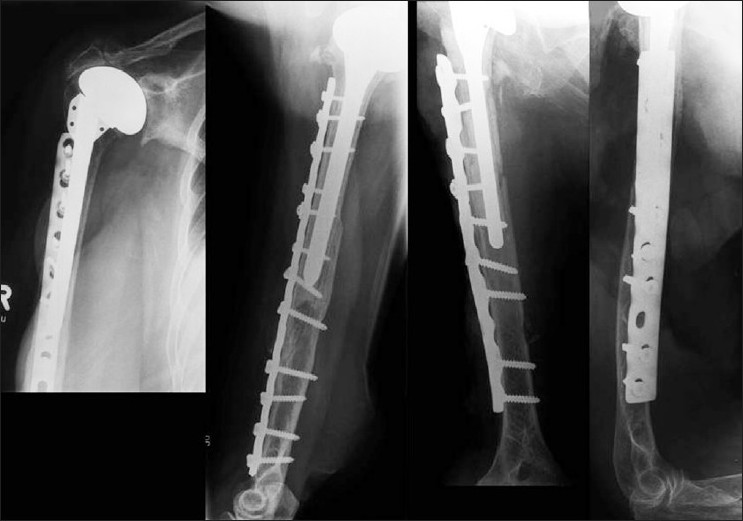 Figure 3: Patient one and two, two years after open reduction and internal fixation with the periprosthetic combination of 3.5 cortical screws with washers and 4.5 plates