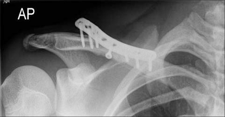 Figure 1: Eight holes Acumed plate with the lateral end lifted up above the clavicle. Fracture united