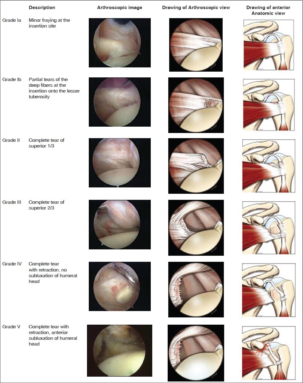 Figure 1: Classification of subscapularis tendon lesions
