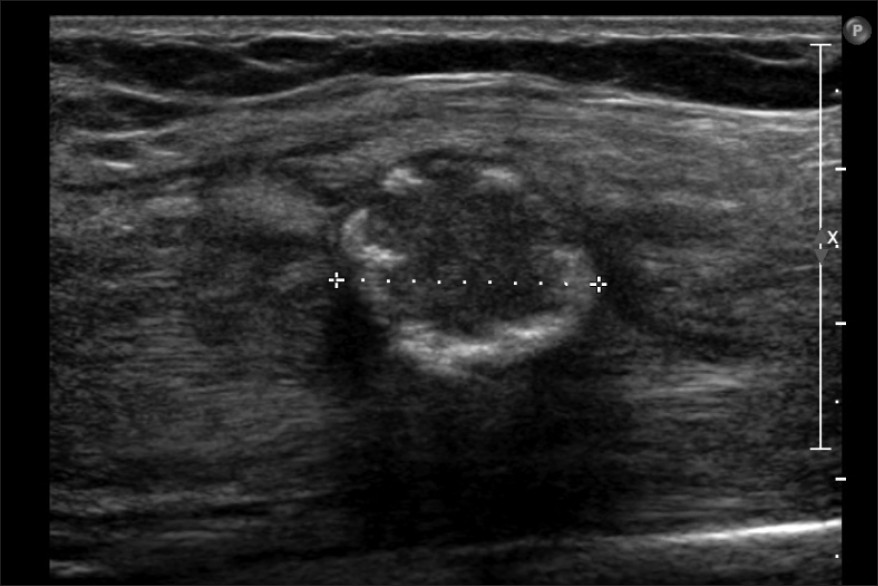 Figure 2: Initial ultrasound confirmed the peripheral calcification of the lesion in the medial caput of the triceps. The diameter of the lesion was 1.7 cm