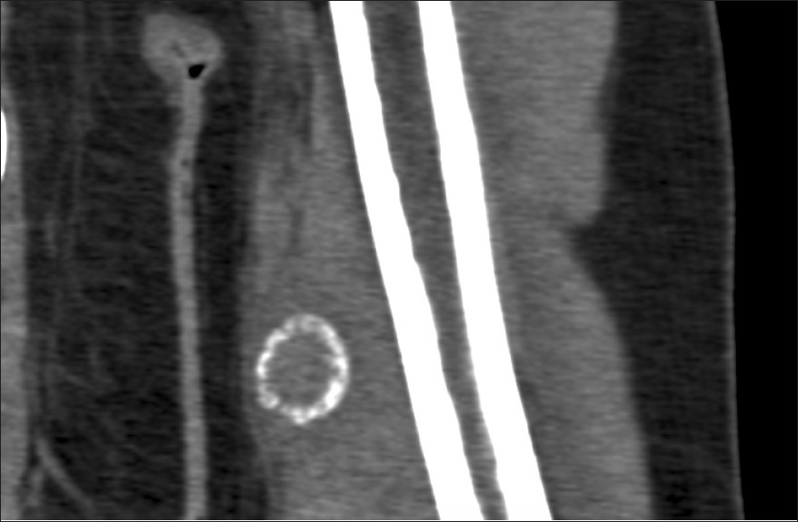 Figure 3: Computed tomography of the lesion showed the characteristic peripheral calcification of the lesion. There are no cortical or bone marrow abnormalities