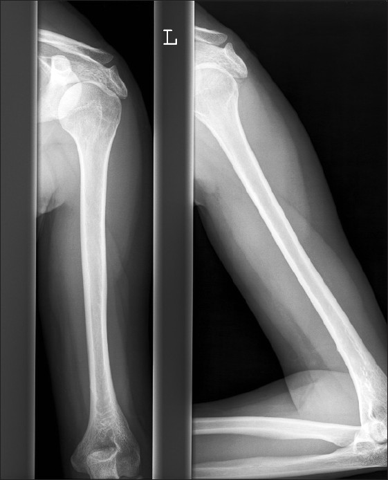 Figure 4: X-ray of the lesion 1 year after diagnosis and conservative treatment, showing complete resolution