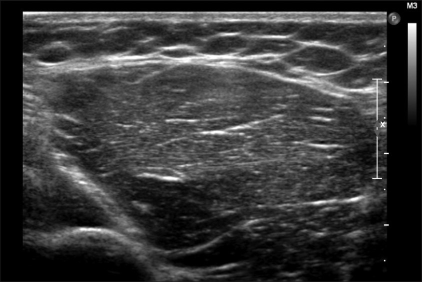 Figure 5: Ultrasound of the lesion 1 year after diagnosis and conservative treatment, showing complete resolution