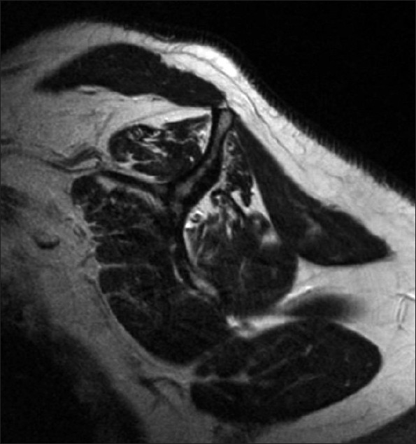 Figure 6: Persistent mild atrophy of the subscapularis (SSC), supraspinatus (SSP) and infraspinatus (ISP) muscles, with moderate fatty muscle infiltration following a successful repair