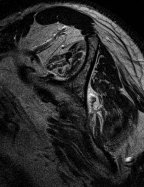 Figure 7: Advanced atrophy and fatty degeneration of rotator cuff muscles in a three-tendon retear