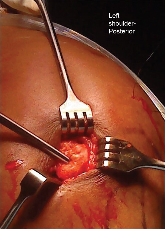 Figure 1: Surgical exposure through a transverse incision in the supraspinatus fossa