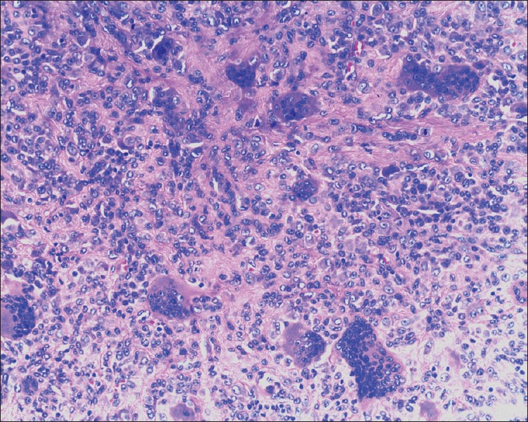 Figure 2: ×20 photomicrograph showing an encapsulated tumor composed of sheets of polygonal to spindle-shaped mononuclear cells with interspersed osteoclast type multinucleate giant cells, histiocytes, and aggregates of foamy macrophages