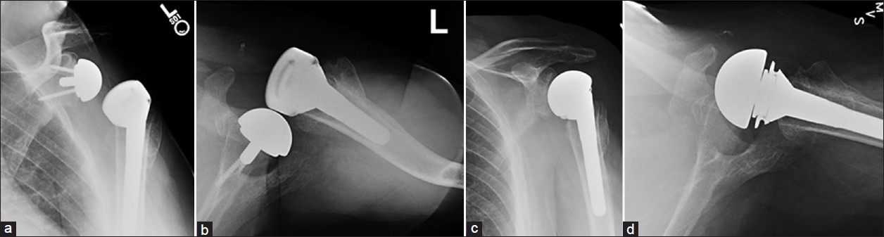 Figure 1: A 58-year-old male (Case 2) presented 6 months after reverse arthroplasty for failed fracture fixation with anterior dislocation of the prosthesis. (a and b) Grashey view and axillary view of the dislocated prosthesis. Notice the superior placement of the glenosphere with slight superior tilt. At the time of revision surgery, no combination of glenosphere or reverse humeral component could result in stability as the prosthesis levered out with adduction past 40 degrees. Removal of a well-fixed glenosphere and baseplate was performed and glenoid bone stock was not sufficient for immediate revision of the baseplate to an improved position. (c and d) Conversion to large head hemiarthroplasty and bone grafting of glenoid defect. Cultures were positive for <i>P. acnes</i> at the time of revision