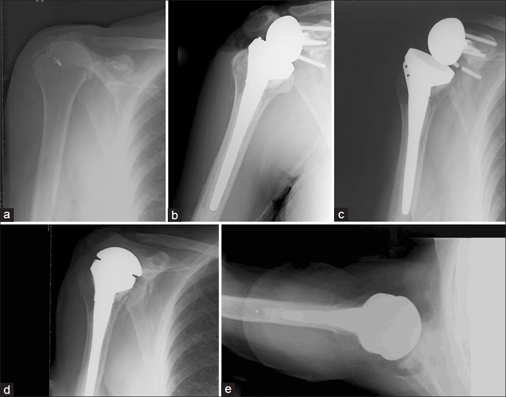 Figure 2: A 74-year-old female (Case 4) underwent reverse replacement for severe cuff tear arthropathy (a). Immediate postoperative radiographs reveal superior placement of glenosphere (b). The glenosphere loosened at 8 months postoperatively with breakage of the inferior screw (c). (d and e) AP and axillary views after conversion to hemiarthroplasty