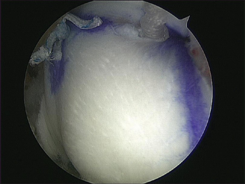 Figure 2: Completed rotator cuff repair with reinforcement Allopatch HD graft (MTF Sports Medicine, Edison, NJ, USA)