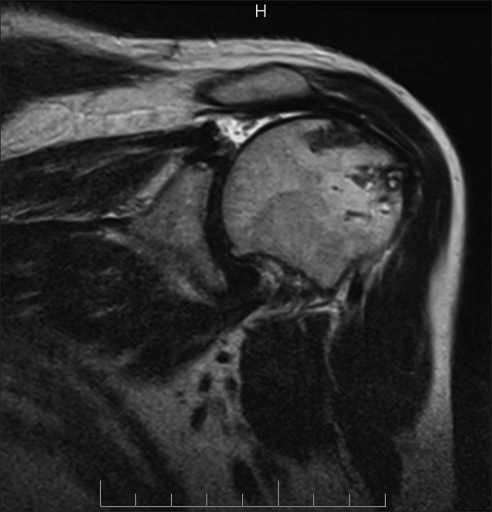 Figure 4: Sugaya Type IV, recurrent minor defect (less than 1 cm) at the medial musculotendinous junction