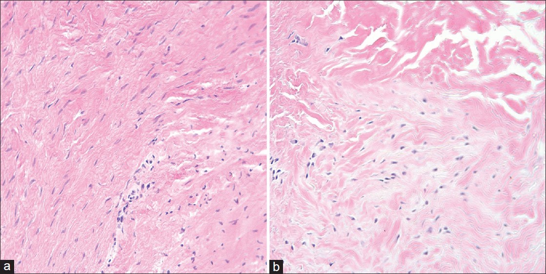 Figure 5: (a) Hematoxylin and eosin stain peripheral graft biopsy (20×). (b) Hematoxylin and eosin stain central graft biopsy (20×)