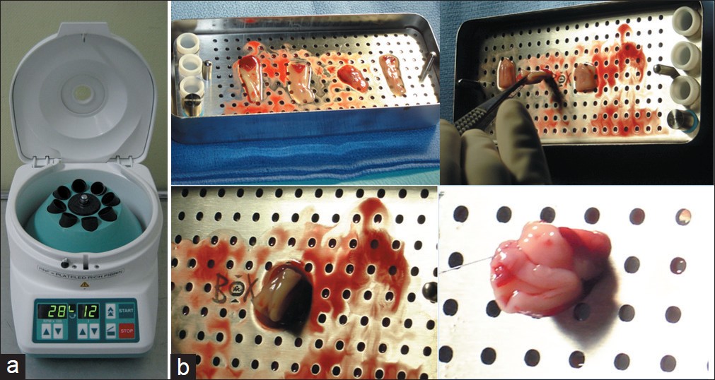 Figure 1: (a) Preparation of L-PRF: A blood sample is taken without anticoagulants in 10 ml tubes which are immediately centrifuged at 400<i>g</i> for 12 minutes. (b) After the centrifugation, the red layer is removed and the L-PRF is folded, stacked, and fixed with an absorbable 4-0 PDS suture