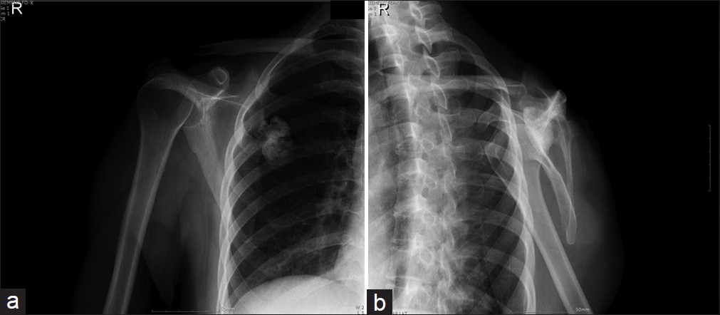 Figure 1 (a, b): Plain radiographs: Exostoses exposed after lifting the scapula off the chest wall