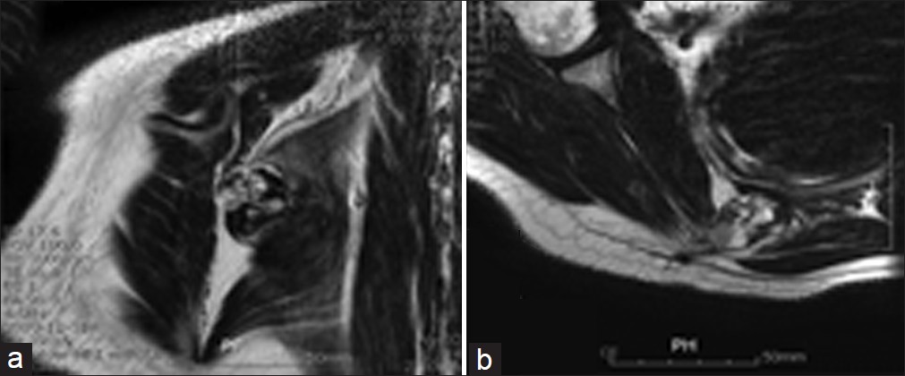 Figure 3 (a, b): MR images demonstrate osteochondroma on the anterior surface of the left scapula and inferior to the spine