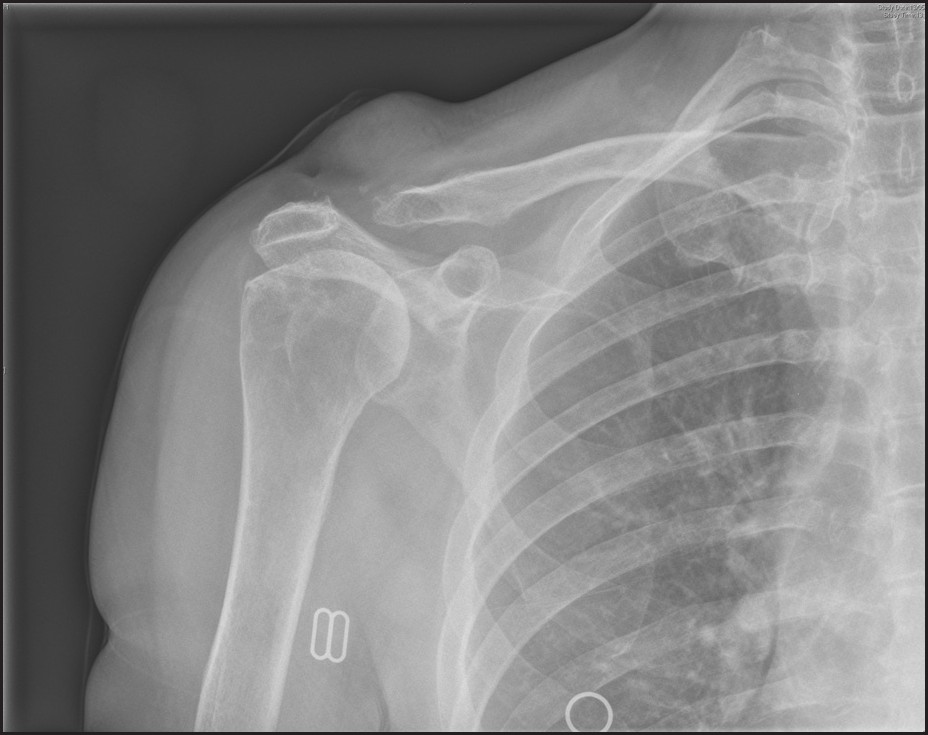 Figure 1: AP radiograph of the shoulder showing a complete loss in the articular surface of the lateral end of the clavicle and resorption of the bone, with prominent swelling above the ACJ