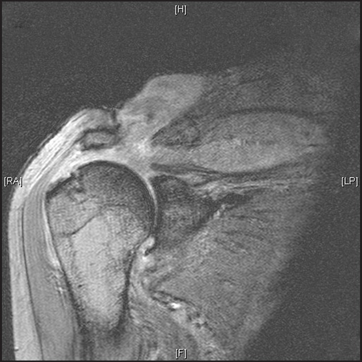 Figure 2: MRI scan showing a large glenohumeral joint effusion with communication with the ACJ via a large rotator cuff defect