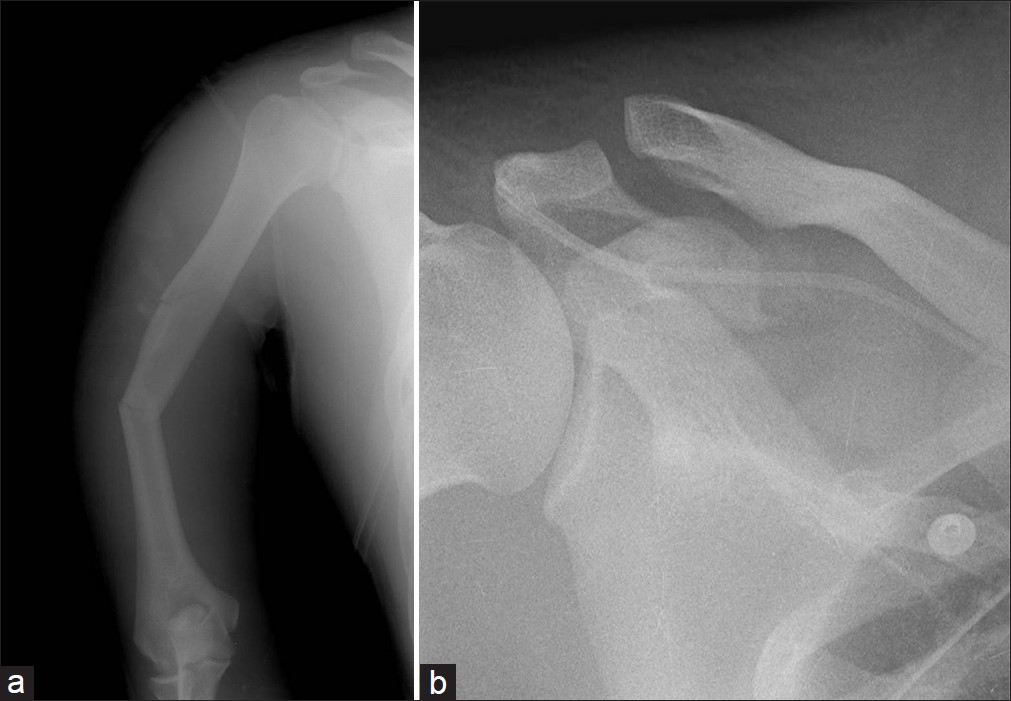 Figure 1: Radiographs demonstrating comminuted fractures in the right scapular superior border, acromion, and coracoid process, and a humerus shaft fracture with acromioclavicular ligament separation