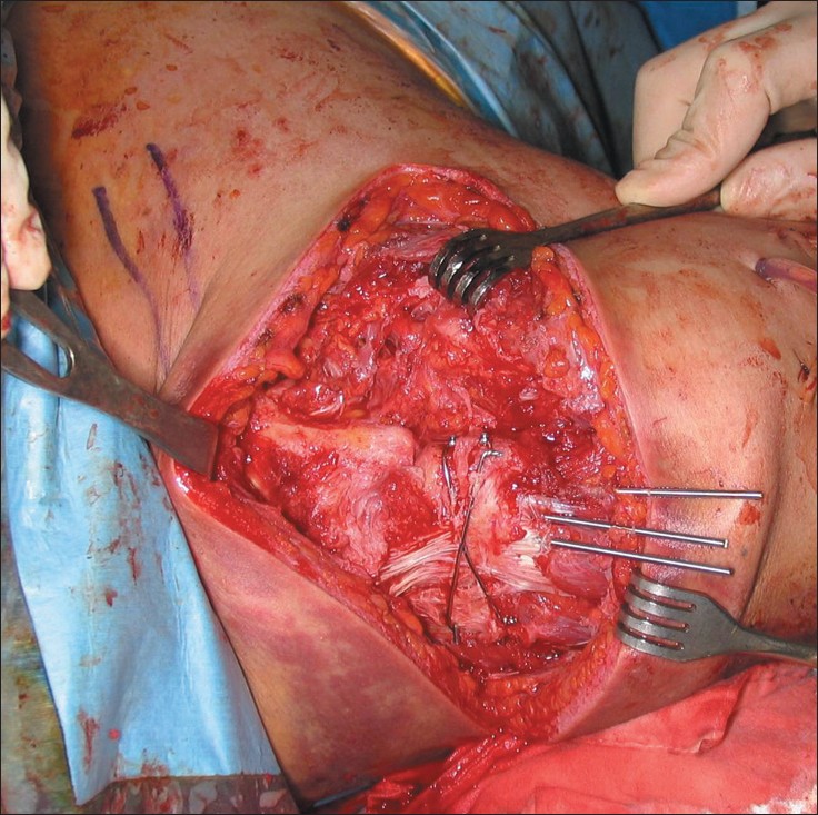 Figure 5: The acromioclavicular joint was fixed using three transarticular S-pins