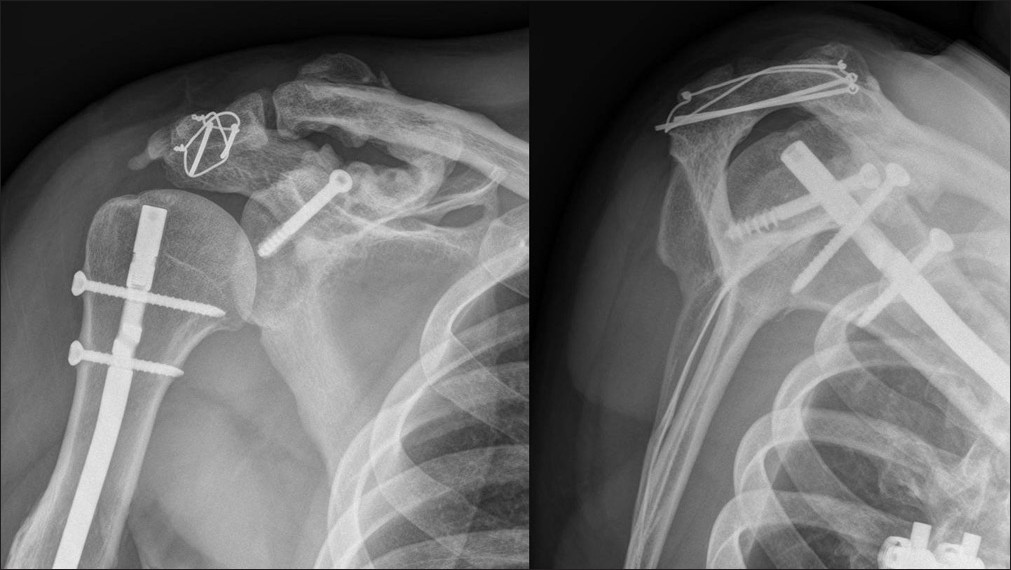 Figure 7: Radiograph taken 5 years after injury