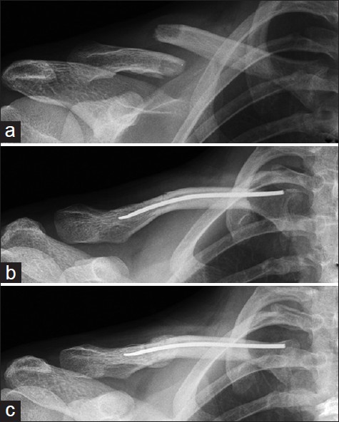 Figure 1: (a) Preoperative radiograph of midshaft clavicle fracture with more than 20 mm of shortening, (b) Immediate postoperative radiograph, and (c) Radiograph at 12 weeks showing healing callus at the fracture site