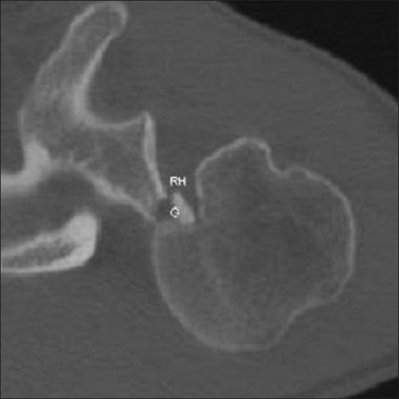 Figure 2: Axial CT of the left shoulder showing the dislocated shoulder with the reverse Hill-Sacs lesion (RH) and laterally displaced fracture of the posterior glenoid rim (G)