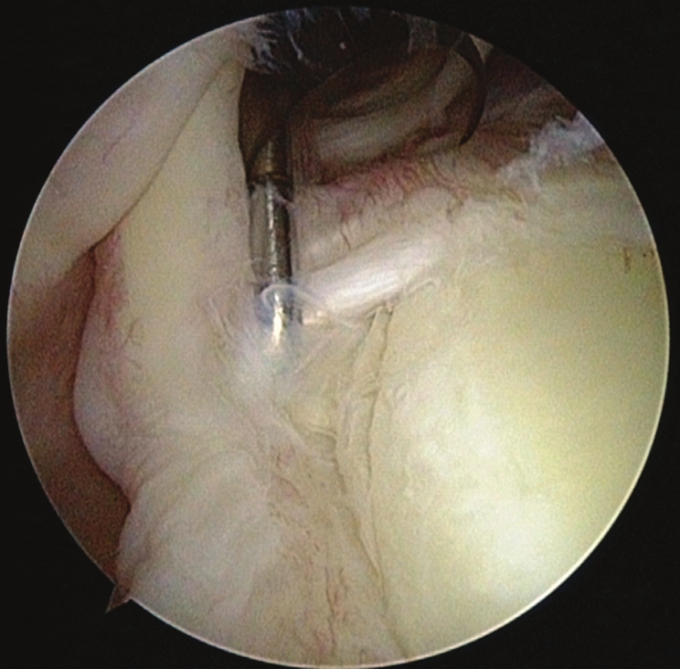 Figure 1: Superior labrum anterior and posterior lesion with unstable biceps anchor point which could be pulled away from the glenoid margin; note fraying of the labrum