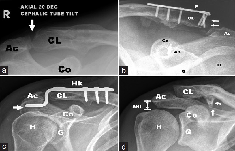 Figure 2: Radiographic outcomes of surgical treatment at follow-up are shown. (a) Acromioclavicular joint degeneration (arrow). (b) Acromioclavicular joint subluxation (arrows), (c) Hook migration and osteolysis of acromial undersurface (arrow), (d) Peri-coracoid ossification (arrows). (Ac: acromion, CL: clavicle, Co: coracoid, P: plate, An: suture anchor, G: glenoid, H: humeral head, Hk: hook plate, AHI: acromiohumeral interval)