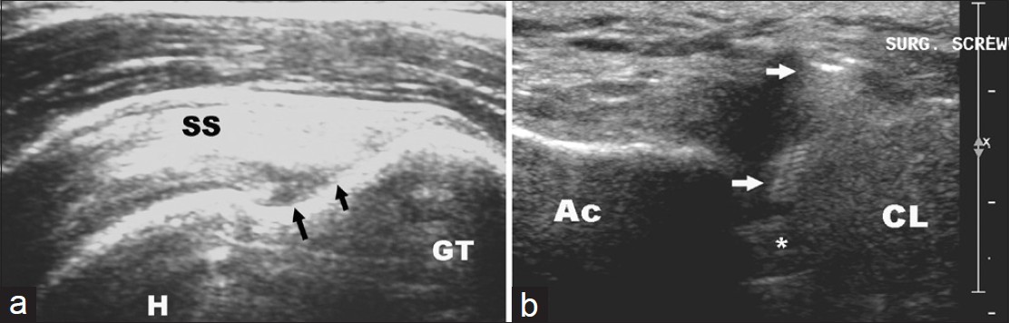Figure 3: Ultrasonographic outcomes of surgical treatment at follow-up are shown. (a) Partial articular-surface supraspinatus tendon avulsion (Black arrows) (b) Screw penetration into the acromioclavicular joint (arrows). (GT: Greater tuberosity, H: Humeral head, SS: Supraspinatus, Ac: Acromion, CL: Clavicle, asterix: Acromioclavicular joint)