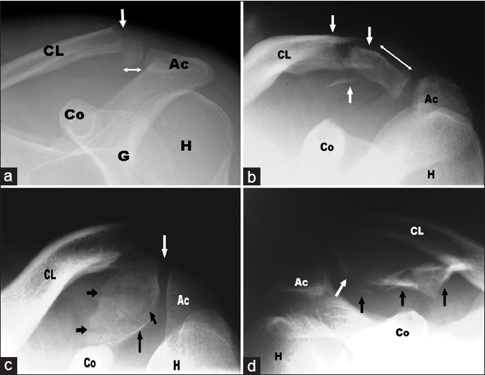 Figure 4: Radiographic fracture patterns: (a) Type 1, (b) Type 2, (c) Type 3, and (d) Type 4. (Ac: Acromion, CL: Clavicle, Co: Coracoid, G: Glenoid, H: Humeral head, arrows: Fracture lines)