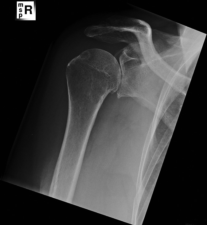 Figure 1: AP X-ray of the right shoulder showing osteoarthritis of the glenohumeral joint