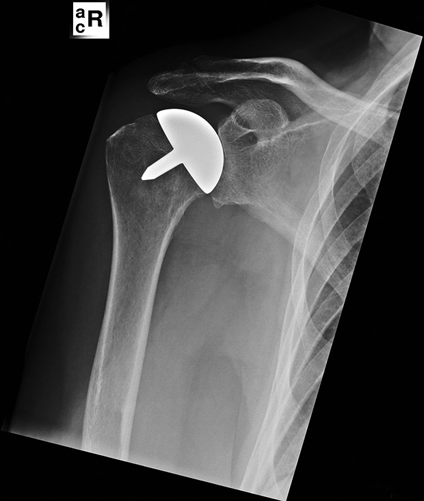 Figure 2: Immediate postoperative X-ray of the resurfacing shoulder prosthesis