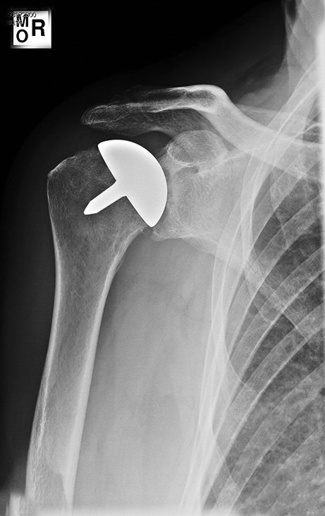 Figure 3: Two years postoperative, the X-ray shows progressive glenoid erosion with a well-positioned prosthesis