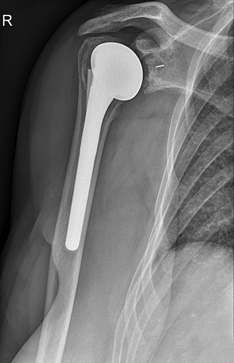 Figure 9: X-ray 2 years postoperative after total shoulder prosthesis
