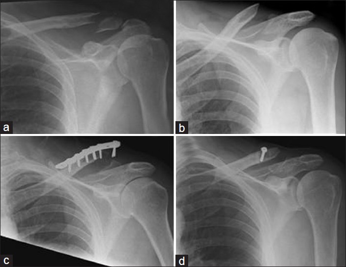 Figure 1: A 58-year-old male with a nonunion of a left lateral clavicle fracture. (a) Acute lateral clavicle fracture. (b) Nonunion of lateral clavicle fracture. (c) Radiographs at 6 weeks showing plate pullout. (d) Revision using stabilization with a coraco-clavicular sling