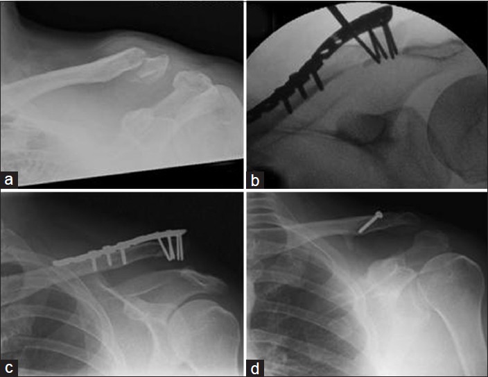 Figure 2: A 43-year-old male with a left lateral clavicle fracture, sustained in a motorbike accident. (a) Acute lateral clavicle fracture. (b) Intra-op fluoroscopic image showing fracture reduction and fixation with a superiorly placed locking plate. (c) Follow-up radiograph showing AC joint dislocation. (d) Follow-up radiograph showing stabilization with a coraco-clavicular sling