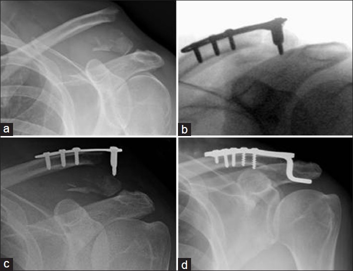 Figure 3: A 48-year-old male with a left clavicle fracture sustained playing rugby. (a) Acute lateral clavicle fracture. Although the ligaments have not ruptured, they have avulsed the inferior aspect of the clavicle and are therefore de-functioned. (b) Intra-op fluoroscopic image showing satisfactory reduction. (c) Follow-up radiograph showing plate pullout. (d) Revision with hook plate