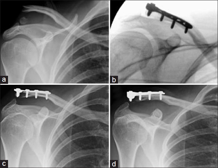Figure 4: A 38-year-old female with a right clavicle fracture from a fall on patio decking. (a) Acute lateral clavicle fracture. (b) Intra-op fluoroscopic image showing satisfactory reduction. (c) Two-week follow-up radiograph showing AC joint subluxation. (d) Four-week follow-up radiograph showing no further progression of AC joint subluxation