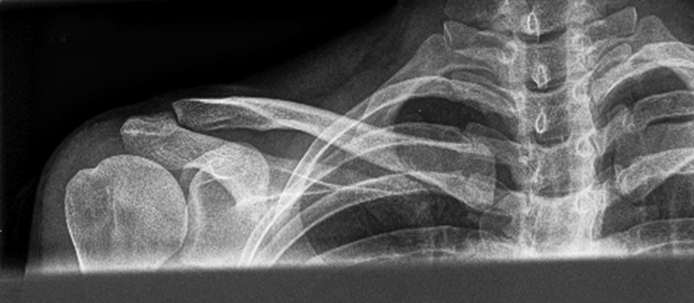 Figure 1: Anteroposterior (AP) view of clavicle. X-ray beam directed perpendicular to coronal plane of body, while standing. X-ray cassette parallel to coronal plane of body