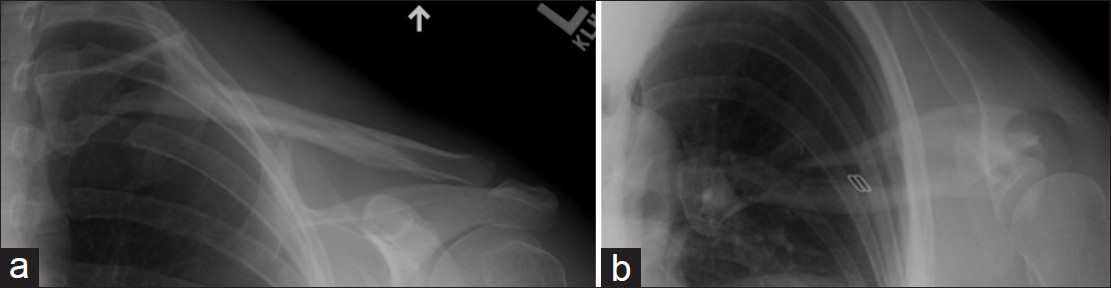 Figure 4: (a and b) Orthogonal views of medial clavicle fracture. Without the 60° caudally angled view, the long oblique fracture line would have been easily missed