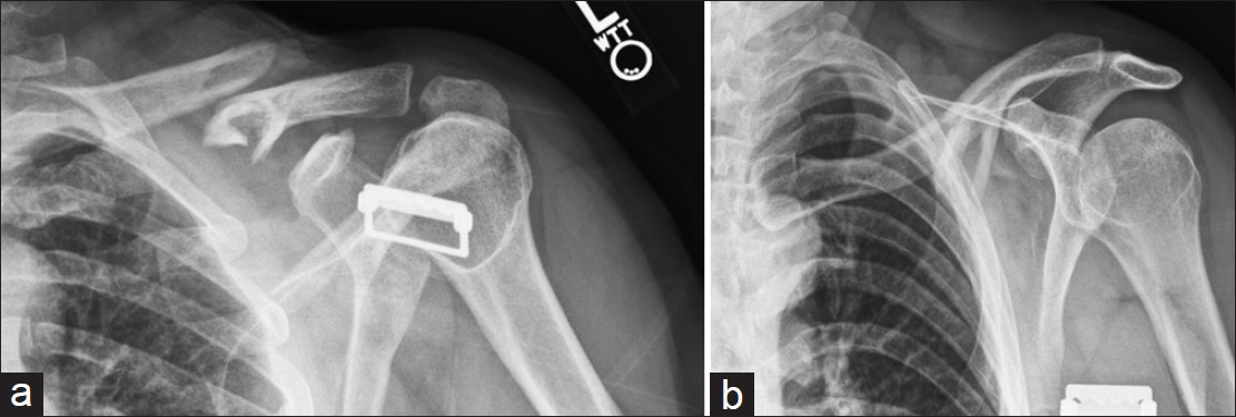 Figure 5: (a and b) Orthogonal views of comminuted, segmental clavicle fracture. The AP view illustrates approximately 100% displacement with an irregular complex appearance of the medial aspect of the lateral fracture fragment, not clearly depicting this area. The 60° caudally angled view identifies a segmental fragment that is angled more in the sagittal plane, plainly seen as the round tubular structure of the midshaft of the clavicle on the traditional clavicle AP view. This segmental fragment could have been easily missed without the former view